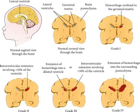 Figure 1 From Germinal Matrix Intraventricular Hemorrhage A Tale Of