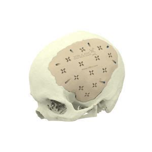 Cranial Implant All Medical Device Manufacturers