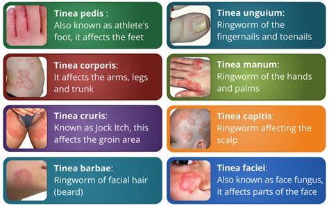 Dr Ajays Homeopathy : Homeopathy is Best for Recurrent Fungal ...