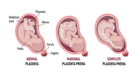 Diario Di Una Gravidanza Maledetta Placenta Previa Pianetamamma It