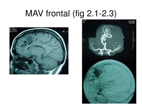 PPT Diagnóstico radiológico de las malformaciones vasculares