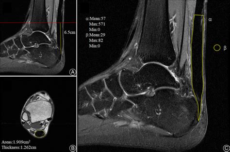 Correlation Between The Coaptation And Regeneration Of Tendon Stumps In