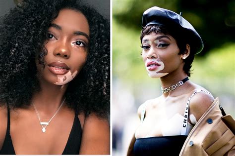 Women With Vitiligo Are Finally Feeling Seen | Glamour