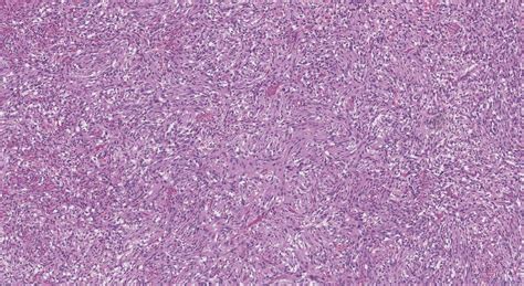 Dedifferentiated Liposarcoma Ottawa Atlas Of Pathology