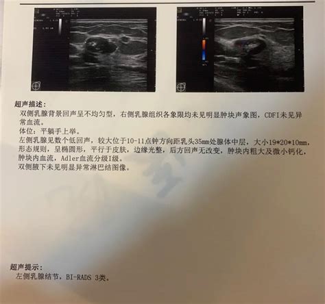 距离癌症只差一步的4a级乳腺结节变3类良性了，我是如何“扭转乾坤”的 知乎