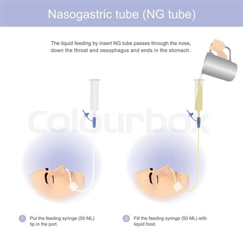 Nasogastric Ng Tube Insertion Osce Guide 55 Off Rbk Bm