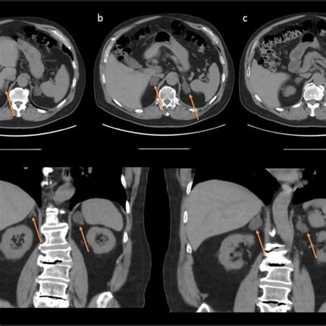 Pdf Mifepristone Treatment In Four Cases Of Primary Bilateral