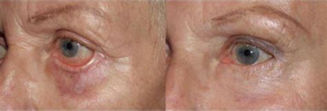 71 Year Old Wife Treated With Eyelid Retraction Repair Results With Dr