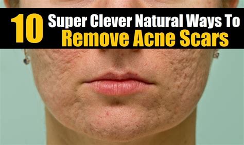 10 Super Clever Natural Ways To Remove Acne Scars