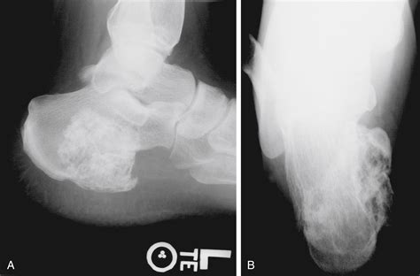 Injection Technique For Calcaneal Spurs Clinical Tree