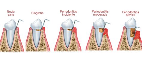 Periodontitis O Piorrea Qu Es Tiene Tratamiento Isabel P Rez