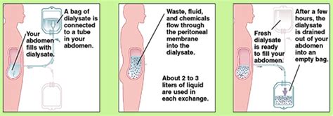 Peritoneal Dialysis - Indications, Complications & Procedure