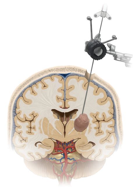 Stereotactic Brain Biopsy What The Patient Needs To Know Aaron Cohen Gadol Md