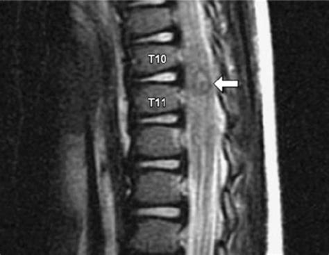 Sagittal T Weighted Mri Of The Thoracic Spine Demonstrating Traumatic