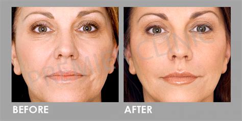 Platelet Rich Plasma Prp Treatment For Age Spots Premier Clinic