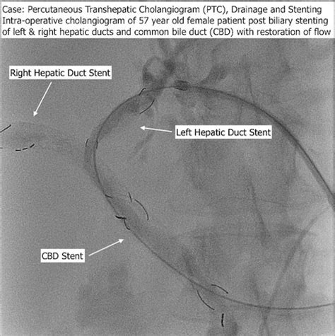 Biliary Intervention Ptc Drainage Stenting Dr Zertalis