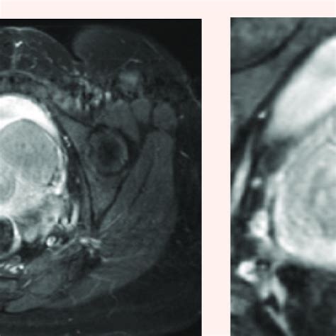 Pelvic T2 Weighted Mri Axial View Demonstrating A 3 8 X 4 1 X 4 7 Cm Download Scientific