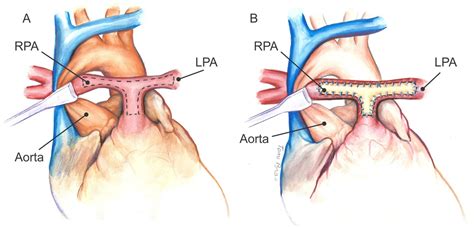 Surgical Repair Of Stenotic Pulmonary Arteries In Tetralogy Of Falllot Intechopen