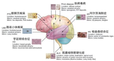 无药可救的神经退行性疾病