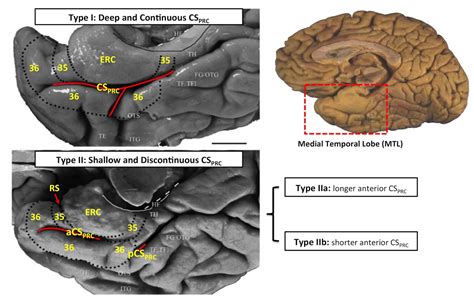 Multi-Template Analysis of Human Perirhinal Cortex in Brain MRI ...