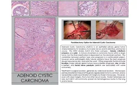 Understanding Adenoid Cystic Carcinoma Prognosis 2024