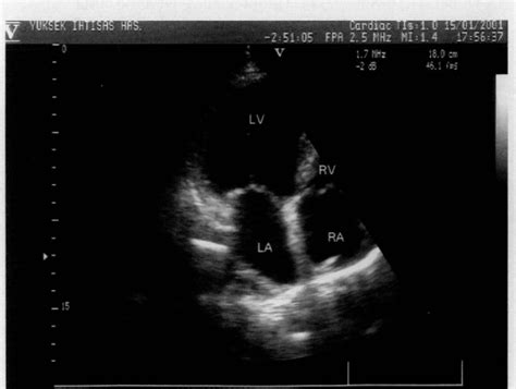 Figure From An Unusual Primary Left Ventricular Hydatid Cyst