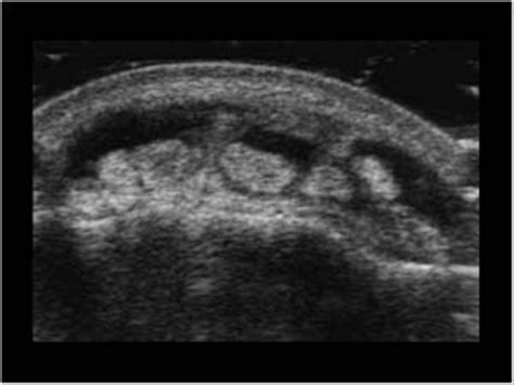 Musculoskeletal Joints and Tendons | 6.3 Wrist and carpus : Case 6.3.3 Tenosynovitis of the ...