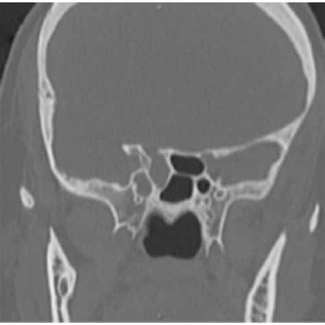 Non-contrast coronal CT of bony defect in optic canal and opacification ...