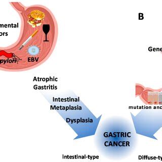 Schematic Representation Of Gastric Cancer Pathogenesis A The