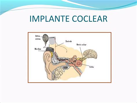 Hipoacusia Neurosensorial E Implante Coclear Dr Omar Gonzales Suazo