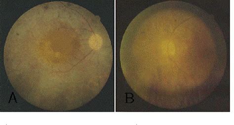 Figure From Bilateral Spontaneous Anterior Lens Dislocation In A