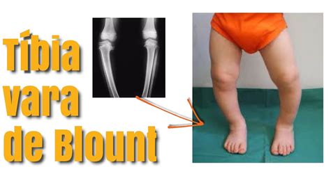 Tibia Vara De Blount Braincp