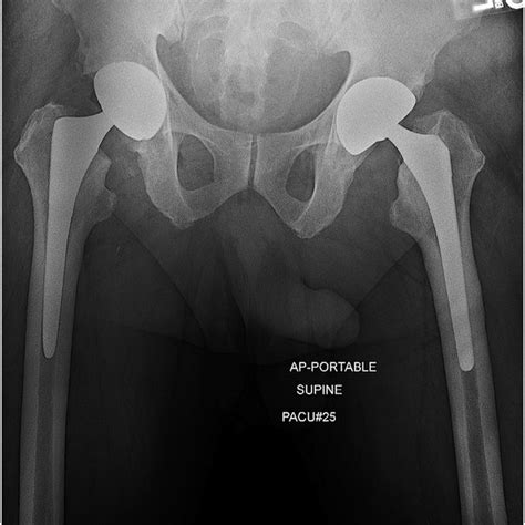 A Anteroposterior Ap Pelvis And B Cross Table Lateral Radiographs