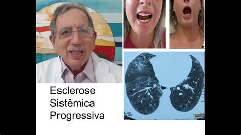 M B Esclerose Sistêmica Progressiva YouTube