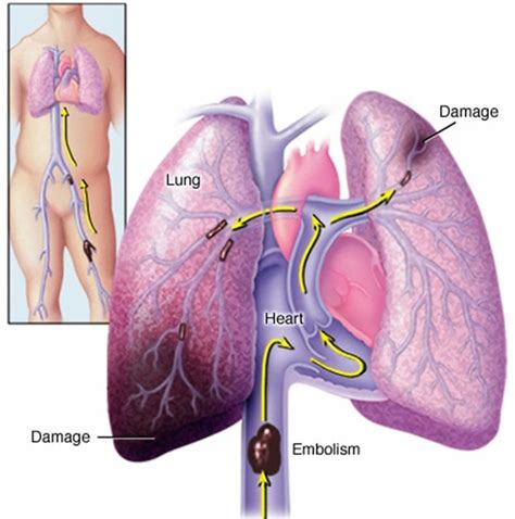 Blood clot causes, symptoms, diagnosis, prevention, prognosis & treatment