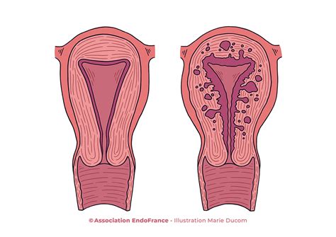 Adenomyosis | HusnaHuzepha