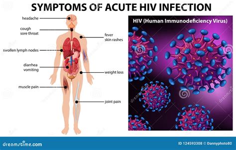 Sintomas Da Infec O Pelo Hiv Aguda Ilustra O Stock Ilustra O De