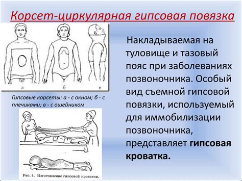 Гипс. Основные виды гипсовых повязок - online presentation