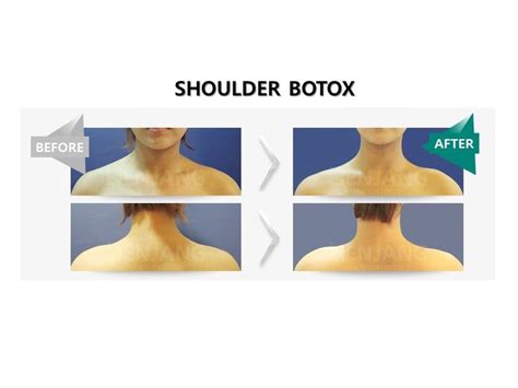 Shoulder Botox Lienjang Plastic Surgery 체형