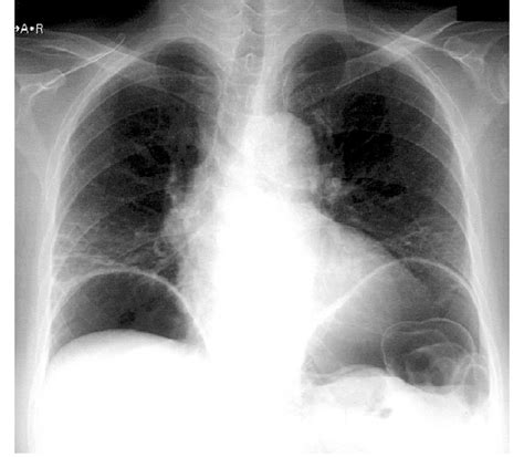 Free Gas Is Seen Below The Diaphragm On Plain Chest Roentgenogram Taken Download Scientific