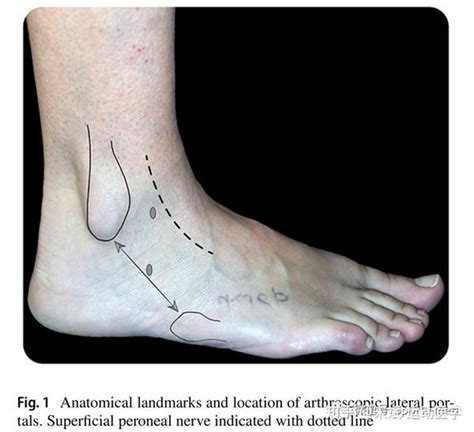 关节镜下伸肌下支持带增强联合broström技术治疗踝关节陈旧性不稳 知乎