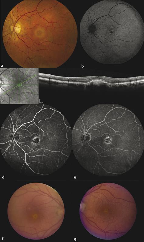 Adult Vitelliform Macular Dystrophy Ento Key