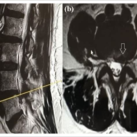 A Sagittal And B Axial Preoperative T2 Weighted Mri Of A Patient In