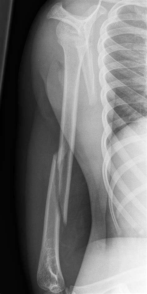 Fractures Humerus