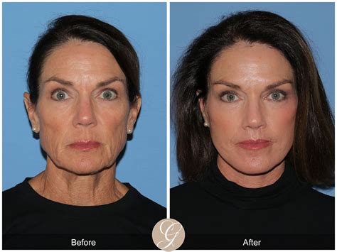 Preservation Facelift Before After Photos Patient 06 Dr Kevin Sadati