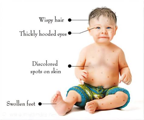 Treatment Of Noonan Syndrome Medizzy