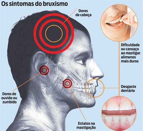 CMDM O que é o Bruxismo