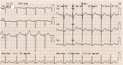 Sinus With St Elevation