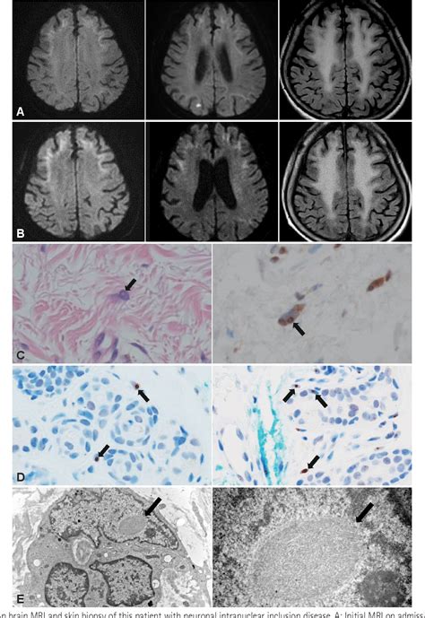 Figure 1 From Adult Onset Neuronal Intranuclear Inclusion Disease