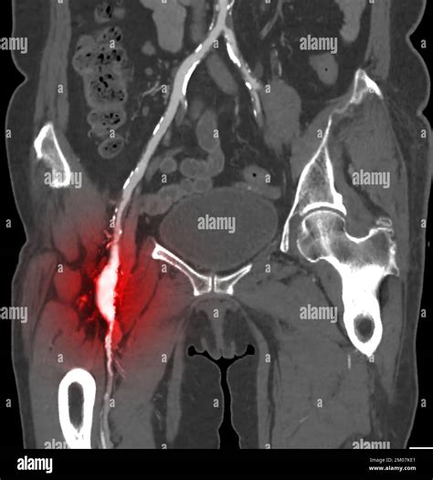 Cta Femoral Artery Run Off Image Of Femoral Artery For Diagnostic Acute